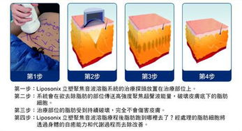 廠家直銷迪姿熱立塑聚焦超聲刀超聲波爆脂減肥機美體塑身儀器熱立塑減肥儀器